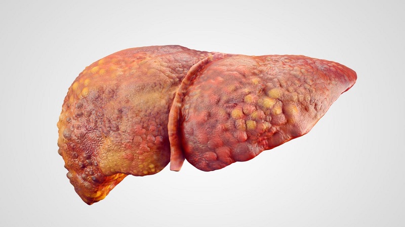 متخصص تغذیه تهران | رژیم غذایی آنلاین | دکتر مریم سبکتکین | رژیم غذایی برای بهبود سیروز کبدی